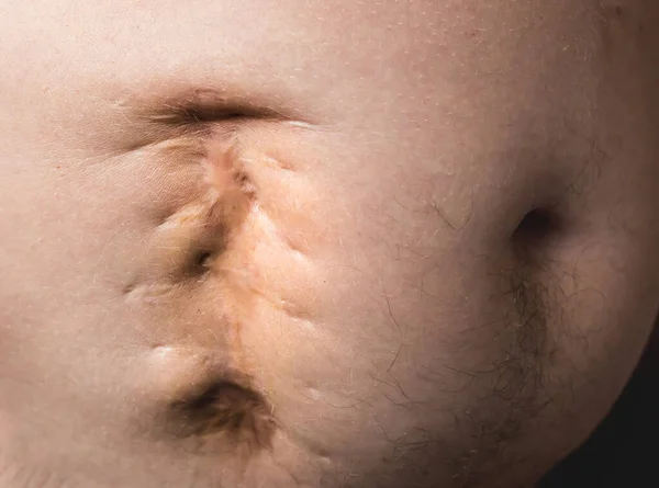 Uma Cicatriz Horrível Barriga Gorda Homem Depois Cirurgia Apendicite Velha — Fotografia de Stock