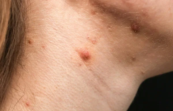 Cicatrices Heridas Cuello Después Del Acné Piel Grasa Mujer Con — Foto de Stock