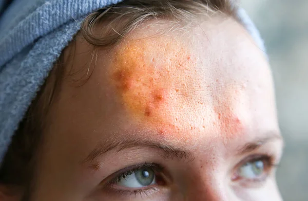 여자는 여드름 기름진 피부를 가지고 있어요 얼굴에 상처와 상처가 여드름을 — 스톡 사진