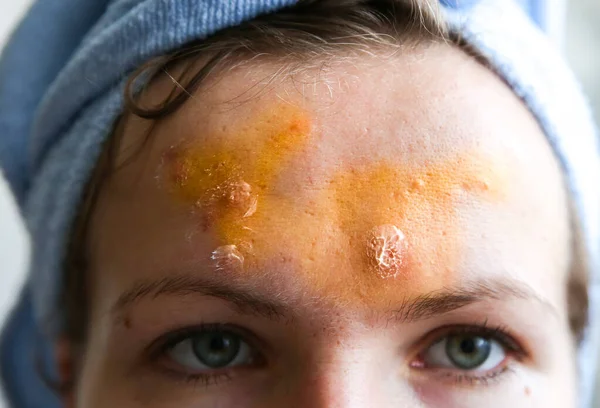 여자는 여드름 기름진 피부를 가지고 있어요 얼굴에 상처와 상처가 여드름을 — 스톡 사진