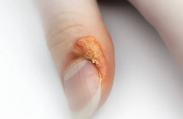 Fecha Wart Com Dedo Doença Cutânea Contagiosa Mão Mulher Tratamento — Fotografia de Stock