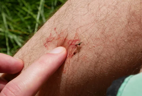 Man Killed Mosquito Blood Leg Insects Bite Summer Dangerous Nature — Stock Photo, Image