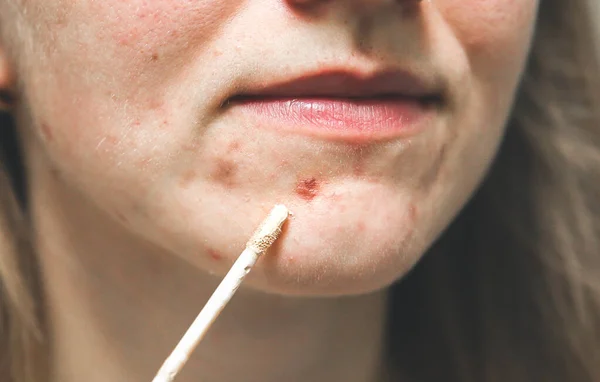 Mujer Está Cubriendo Acné Con Corrector Maquillaje Para Piel Grasa — Foto de Stock
