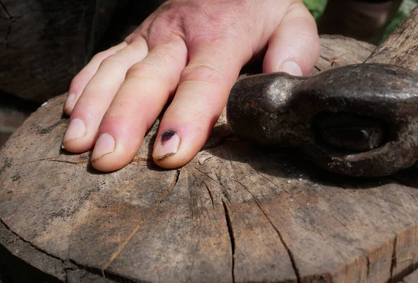 Hammare Och Människofinger Med Mörka Blåmärken Nageln Fingerskada Svart Hematom — Stockfoto