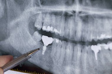 Doktor diş implantıyla insan dişlerinin panoramik röntgenini öğreniyor. Dişçi postası. Diş dolgusu, kaplama, tahsis edilmiş hastalıklı dişler..