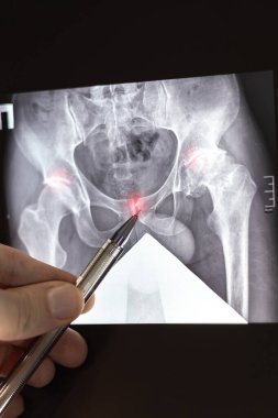 Doktor dissplastic coxarthrosis 'in dikey röntgenini öğreniyor. Sol femoral kafa deformasyonu. Aseptik nekroz ve kalça ekleminde büyük kistik değişiklikler. Sol alt uzvu kısaltan projektif.