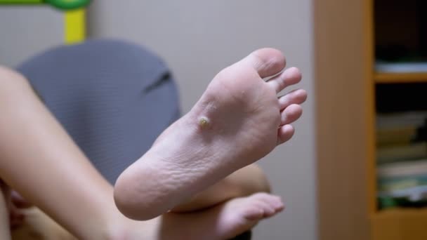 Kind toont een voet met een maïs en een Wart erin. Vlakke voeten. Close-up — Stockvideo