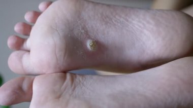 Callus ve Wart Feet on Plantar Plat Flat in Child. Düz taban. Yakın plan