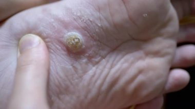 Callus ve Wart bir Plantar Flat Foot in a Child. Teftiş, Parmak Basma