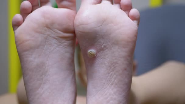 Calus and Wart Feets on Plantar Flat foot in Child.平らな足だ。クローズアップ — ストック動画