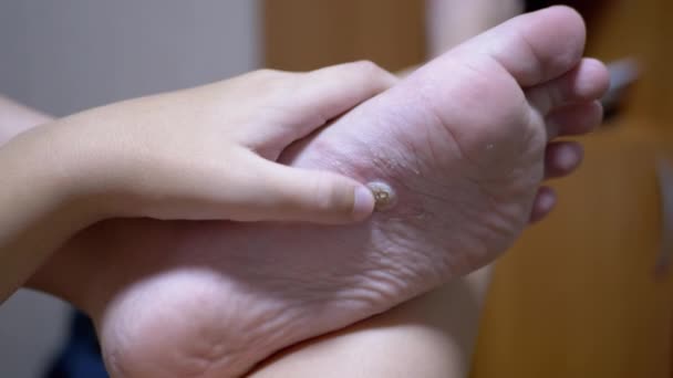 Child Presses Finger on Callus and Wart Feet on Plantar Flat Foot — Stok Video