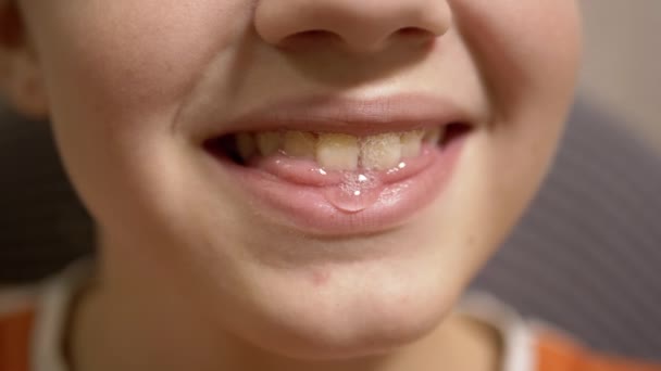 Humoristiskt roligt leende med Tooths of Teenage Boy som dreglar. 4K. Långsamma rörelser — Stockvideo