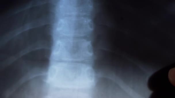 Radiografía de columna vertebral, costillas, huesos de un niño pequeño. Curvatura de la columna. Cifosis. 4K — Vídeo de stock