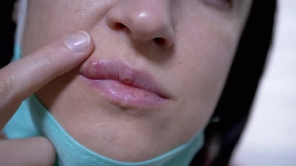 Rapariga mostra vírus Herpes em lábios, que ela esconde sob uma máscara médica. 4K — Vídeo de Stock