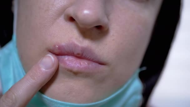 Молодая девушка показывает вирус герпеса на губах, который она прячет под медицинской маской. 4K — стоковое видео