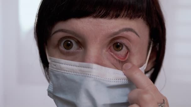 Jong meisje in masker draait rood, bloeddoorlopen ogen. Virale Conjunctivitis. 4K — Stockvideo