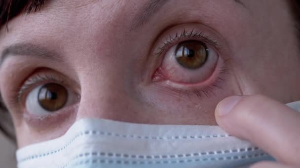 Jeune fille en masque tourne rouge, yeux injectés de sang. Conjonctivite virale. Zoom — Video