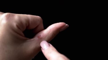 Deri yanığı ya da yarası olan kadın ayası, Siyah Arka plan. Başparmağın yanındaki deride iyileşme yarası. Yanık tedavisi konsepti, yaralanma, ciltteki iyileşme yarası. Yakın plan. Boş boşluk.