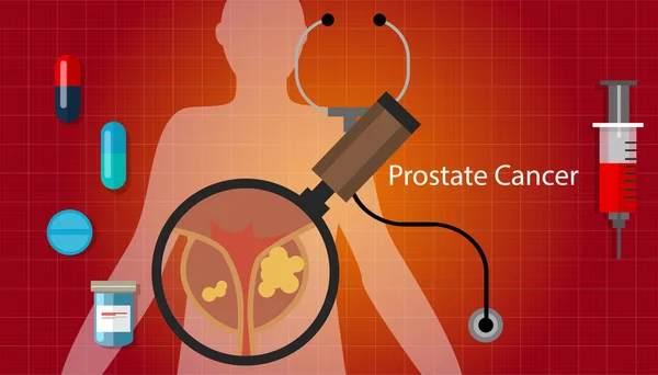 प्रोस्टेट कैंसर स्वास्थ्य चिकित्सा चित्रण दवा उपचार — स्टॉक वेक्टर