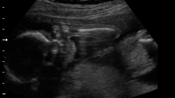 Fetus ultrasound of baby — Stock Video