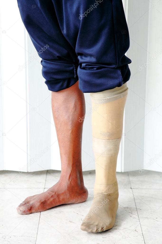 Amputee wearing a prosthetic leg standing, close up view of their leg and the prosthesis