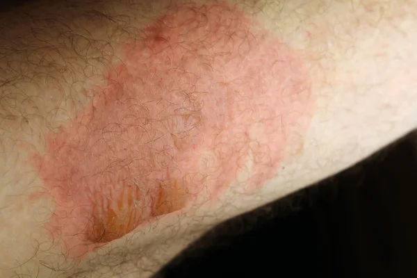 Thermal injuries. Burn the legs of the second degree — Stock fotografie