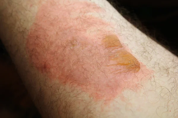 Thermal injuries. Burn the legs of the second degree