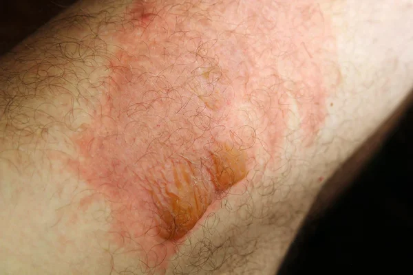 Heridas térmicas. Quemar las piernas del segundo grado —  Fotos de Stock