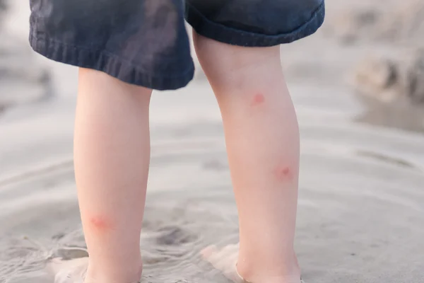 Red itchy  bites on toddler boys legs — Stock Photo, Image