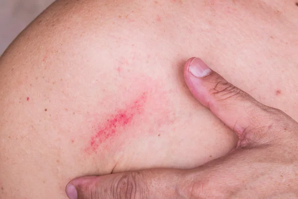Пальцы обнимают небольшие синяки на коже между плечом и грудью — стоковое фото