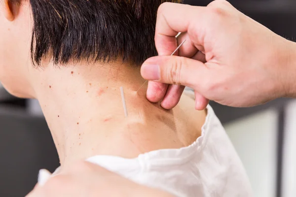 フィールドの浅い深さの皮膚に針をチクチク鍼灸師 — ストック写真