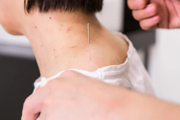 Acupuncturist needle pricking into skin, with shallow depth of field — Stock Photo, Image