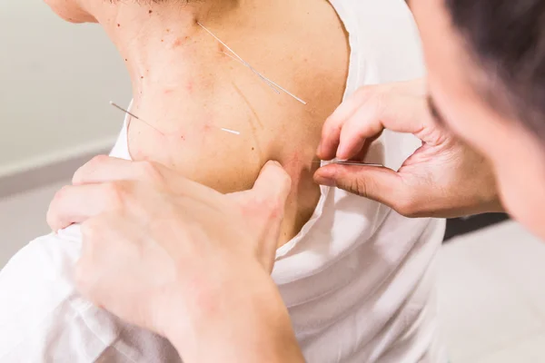 Acupuncturist pricking needle into skin, with shallow depth of field — Stock Photo, Image