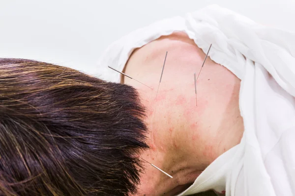 Agulha de acupuntura picada na pele, com profundidade de campo rasa — Fotografia de Stock
