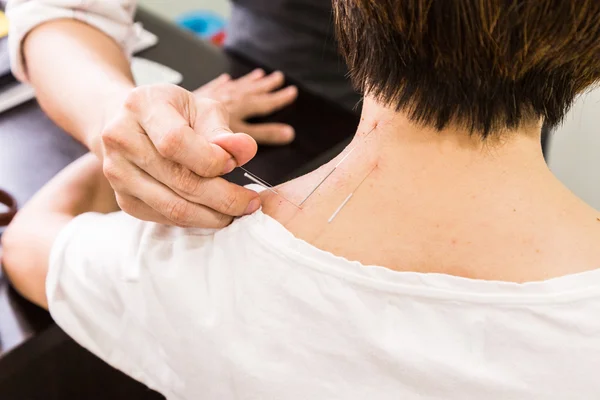 Acupuncturist punking needle into skin, with shallow depth of field — стоковое фото