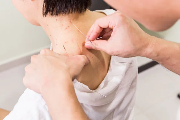 Akupunktör prickning nål i huden, med kort skärpedjup — Stockfoto