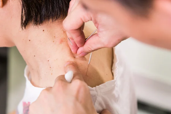 Akupunkturista píchající jehlu do kůže, s malou hloubkou ostrosti — Stock fotografie