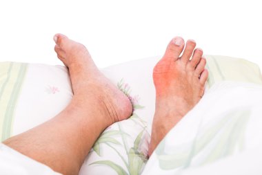 Right foot with painful swollen gout inflammation resting on bed clipart