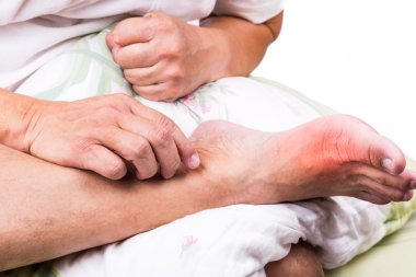Adam acı şişmiş gut inflamasyon ile yatak kucaklama yürüyerek