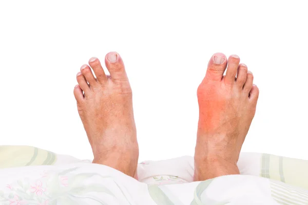 Right foot with painful swollen gout inflammation resting on bed — Stock Photo, Image