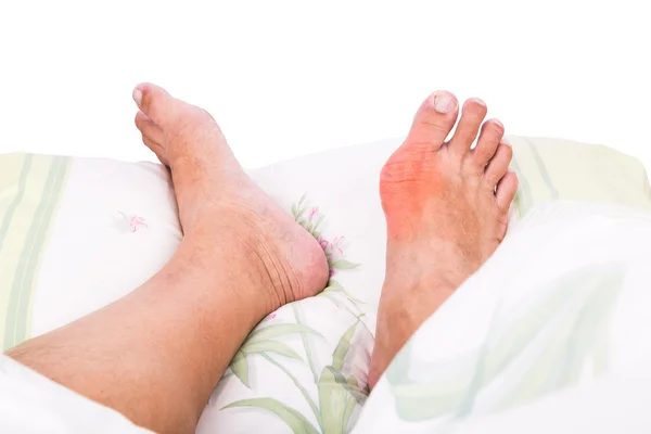 Höger fot med smärtsamma svullna gikt inflammation vilar på sängen — Stockfoto