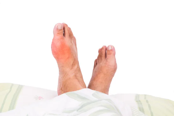 Prawą nogę z Bolesny obrzęk dny zapalenie spoczywa na łóżko — Zdjęcie stockowe