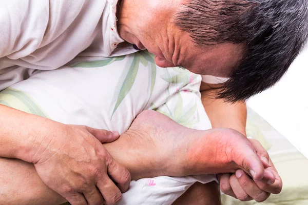Мужчина на кровати обнимает ногу с болезненным воспалением подагры — стоковое фото