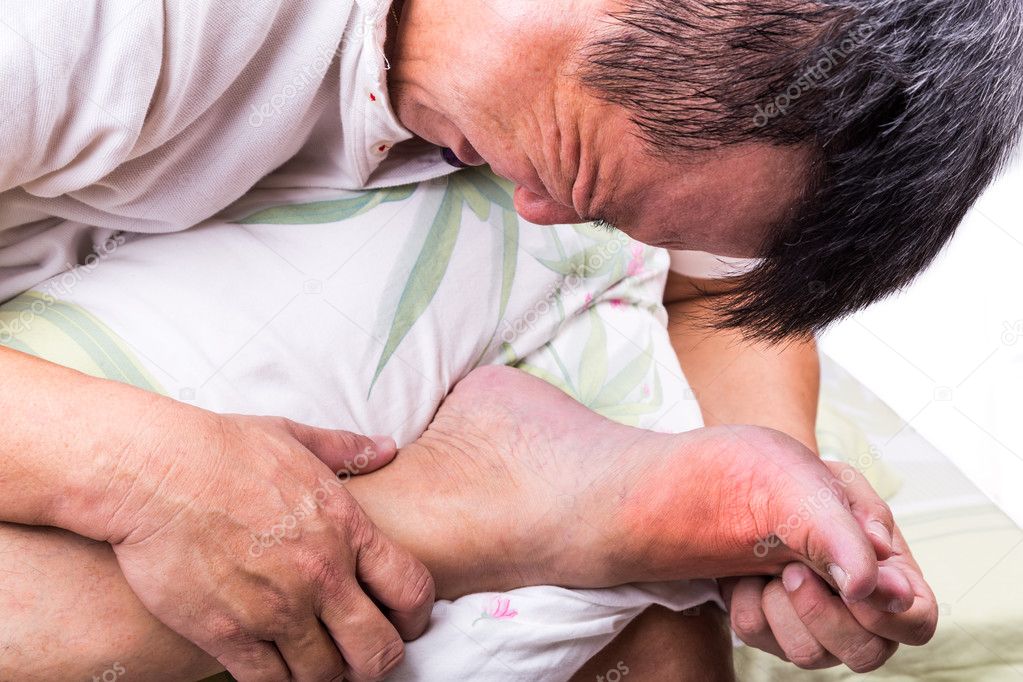 Man on bed embrace foot with painful swollen gout inflammation