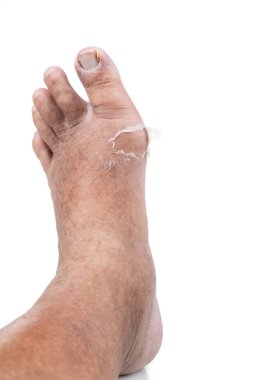 Gut krizinden iyileşen ayak eklemleri ve iltihaplı bölgeden sıyrılan eski deriler..