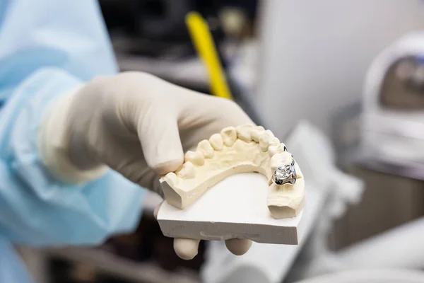 Dentist holding dental prosthesis imprint with metal crown on molar tooth — Stock Photo, Image