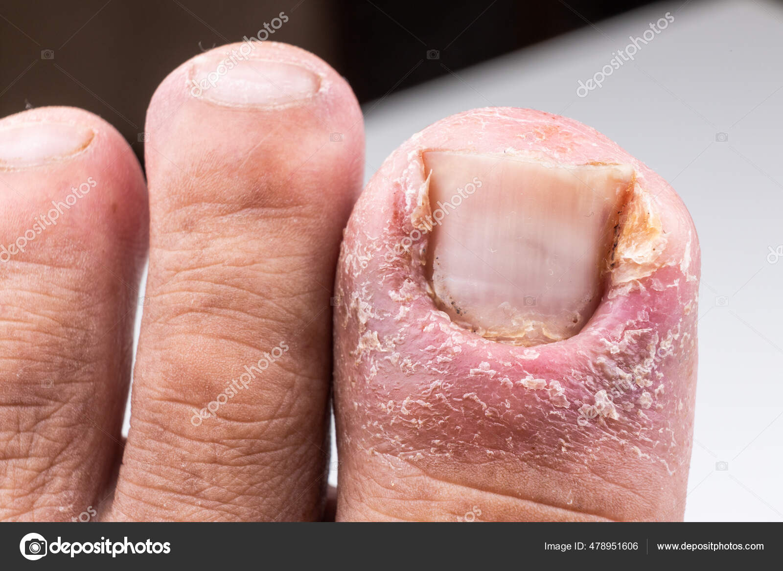 Pseudomonas bacterial nail infection - Stock Image - C049/5542 - Science  Photo Library