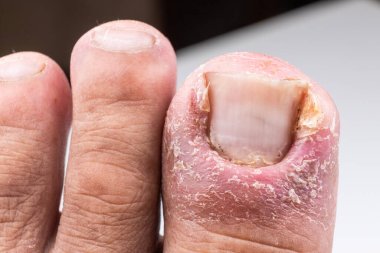 Closeup of painful inflammed infection of the big toe due to ingrown toenail clipart