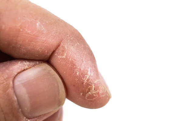 Close-up van pijnlijke ontstoken beschadigde droge huid op de vinger — Stockfoto