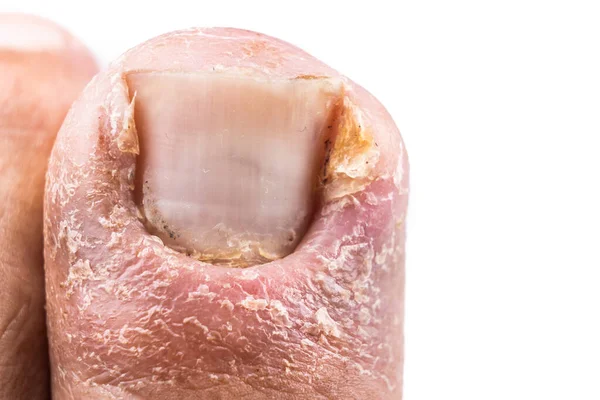 Крупним планом хворобливе запалене зараження великого пальця ноги через врослого нігтя — стокове фото